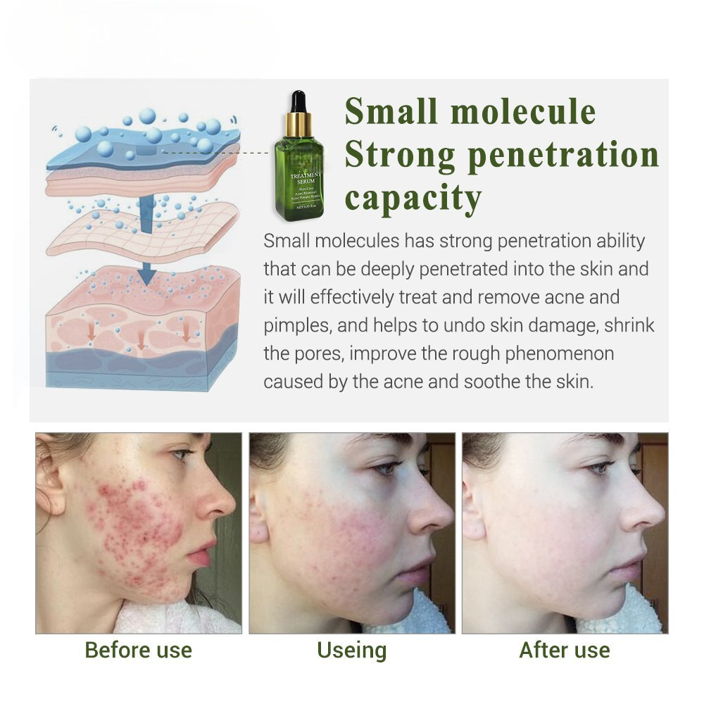 Acne Pimple Remover Serum