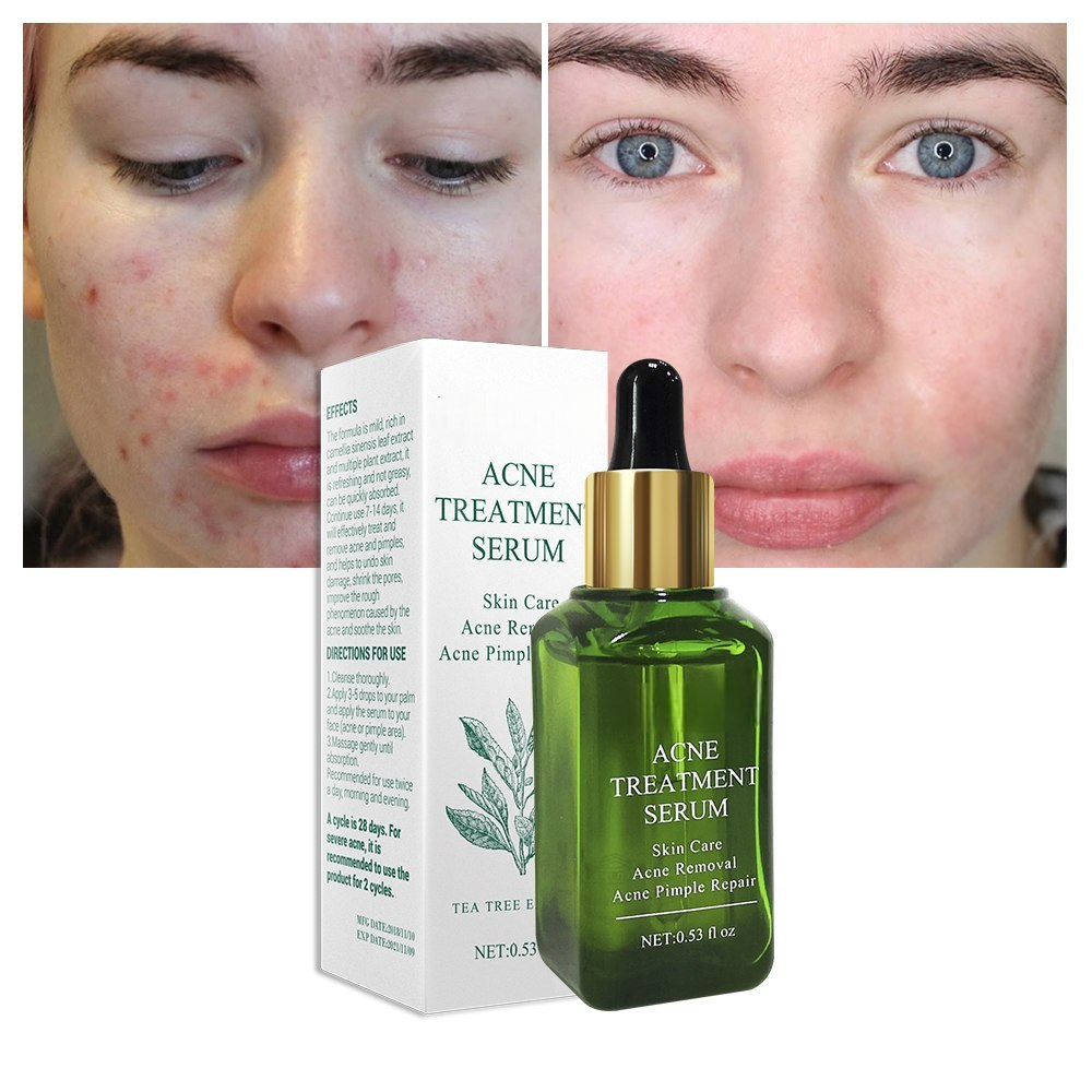Acne Pimple Remover Serum